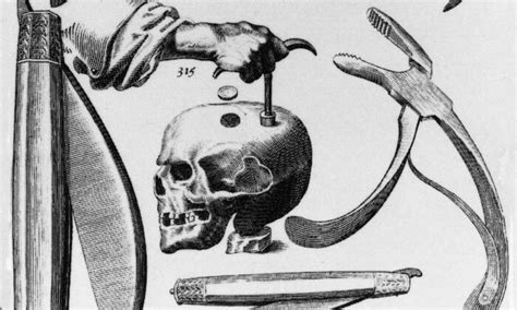 what does trepanning do